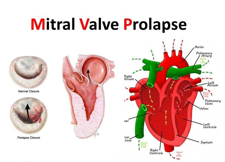 Ayurvedic Treatment For Mitral Valve Prolapse